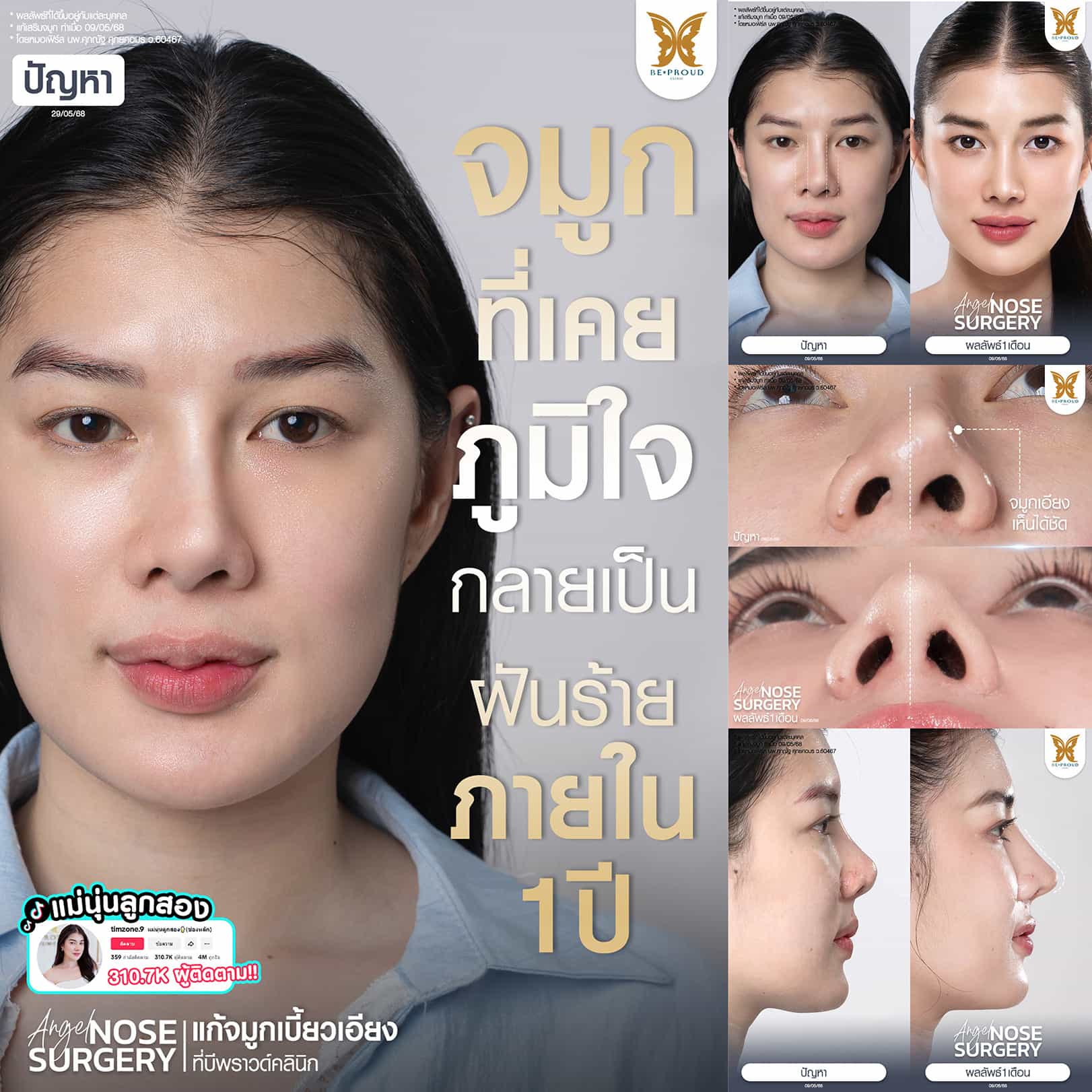 จาก "ฝันร้าย" กลายเป็นทรงในฝัน! รีวิวแก้จมูกของคุณนุ่น ที่ บีพราวด์ คลินิก เปรียบเทียบก่อนทำและหลังทำ ปัญหาก่อนทำจมูกเบี้ยวเอียงชัดเจน ผลลัพธ์หลังแก้ด้วยเทคนิค Slope Angel Nose Surgery ให้กลับมาตรงสวยใน 1 เดือน โดยหมอเฟิร์ส