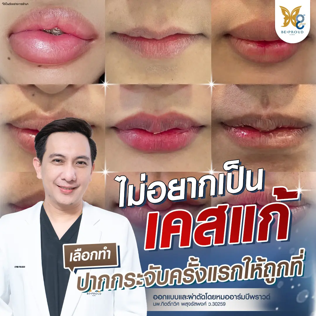 หมออาร์ม นพ.กิตติ์ภวิศ พสุจรัสพงศ์ บีพราวด์คลินิก และรีวิวปากกระจับสวยธรรมชาติ พร้อมข้อความเตือนใจ ไม่อยากเป็นเคสแก้ เลือกทำปากกระจับครั้งแรกให้ถูกที่ เพื่อลดความเสี่ยงปากพัง