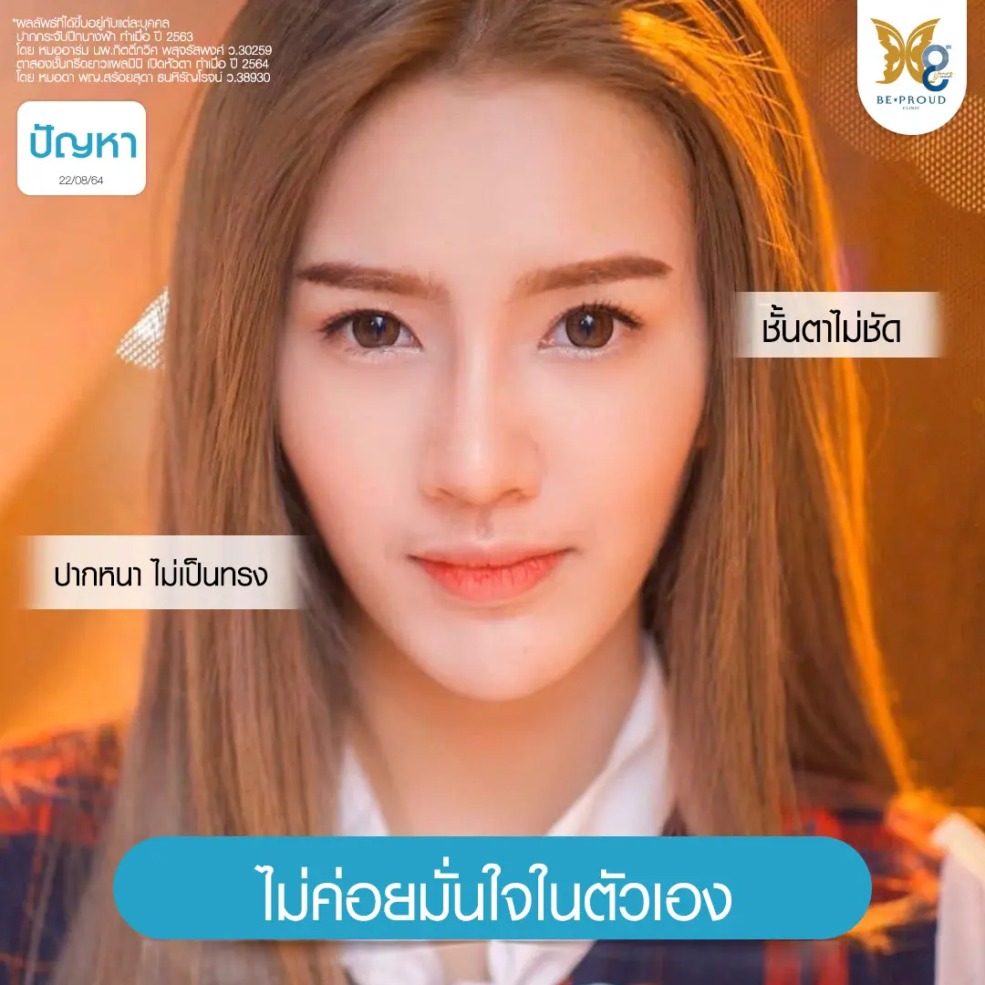 ภาพหน้าตรงคุณแอลตูนก่อนทำศัลยกรรมที่บีพราวด์คลินิก แสดงปัญหาชั้นตาไม่ชัด และปากหนาไม่เป็นทรง ทำให้ขาดความมั่นใจ