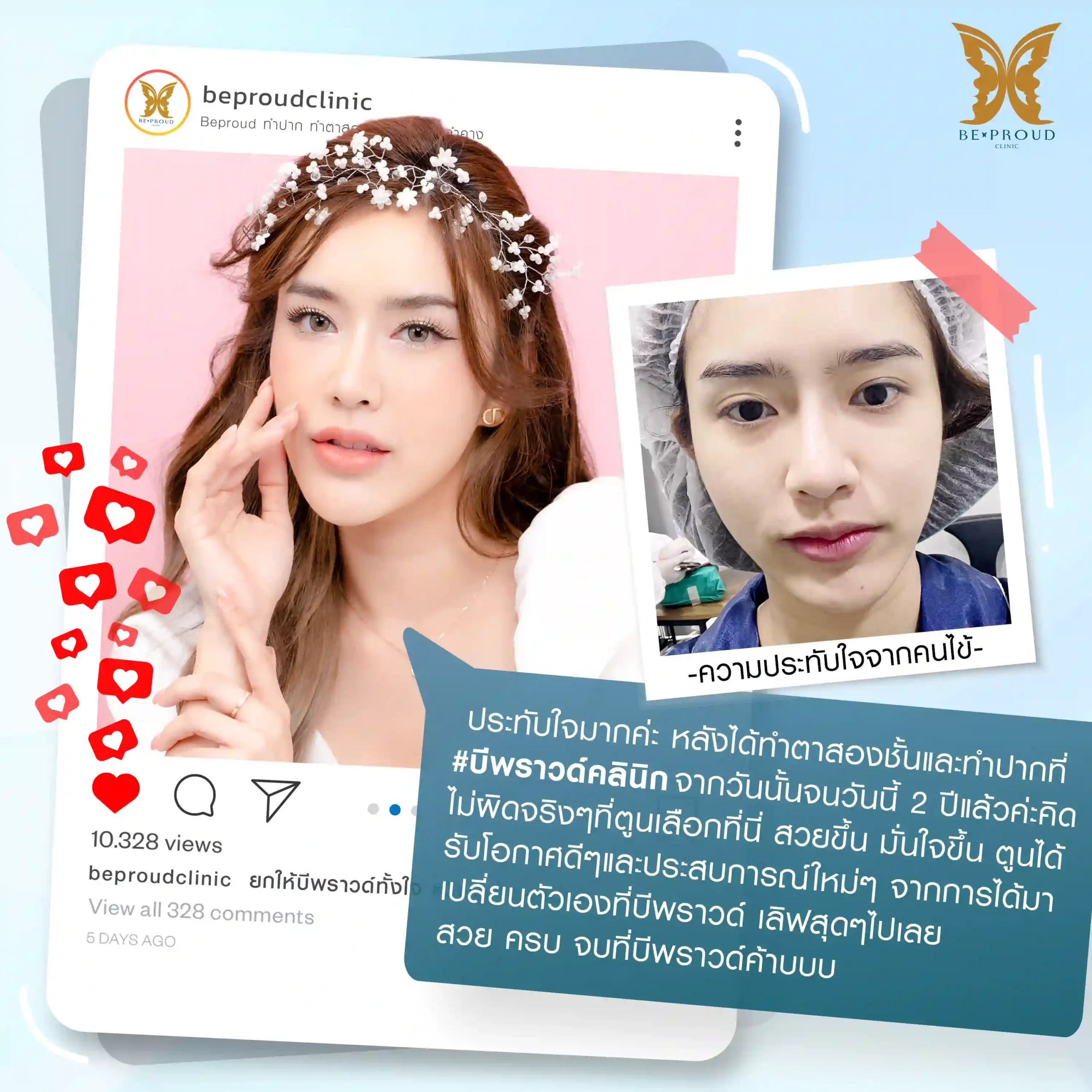 รีวิวจากคุณแอลตูน (@elletoonsky24) ถึงความประทับใจหลังทำตาสองชั้นและปากกระจับที่บีพราวด์คลินิก ครบ 2 ปี ระบุข้อความว่า สวยขึ้น มั่นใจขึ้น สวย ครบ จบที่บีพราวด์
