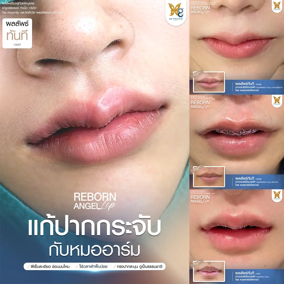 รีวิวผลลัพธ์ทันทีหลังแก้ปากกระจับเทคนิค Reborn Angel Lip โดยหมออาร์ม บีพราวด์คลินิก แก้ปัญหาขูดฟิลเลอร์และยกมุมปาก ฝีเย็บละเอียด ซ่อนปมไหม ทรงปากละมุนเป็นธรรมชาติ