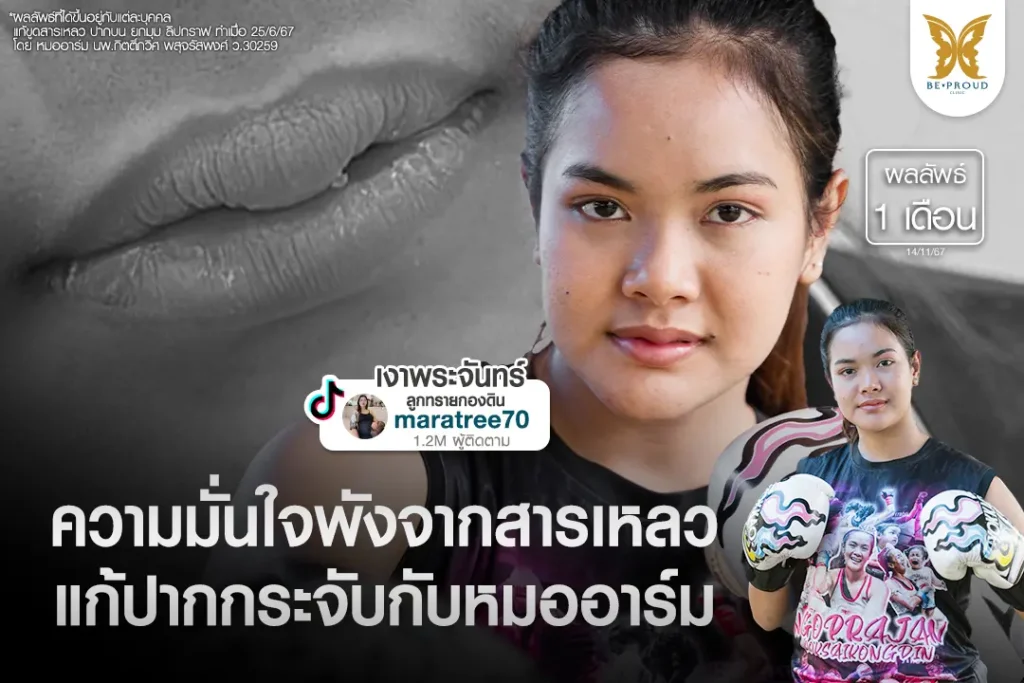 ภาพรีวิวคุณมาราตรี (เงาพระจันทร์) นักมวยหญิง แก้ปากกระจับขูดสารเหลวกับหมออาร์ม บีพราวด์คลินิกเปรียบเทียบผลลัพธ์หลังทำ 1 เดือน ทรงปากสวยธรรมชาติขึ้น