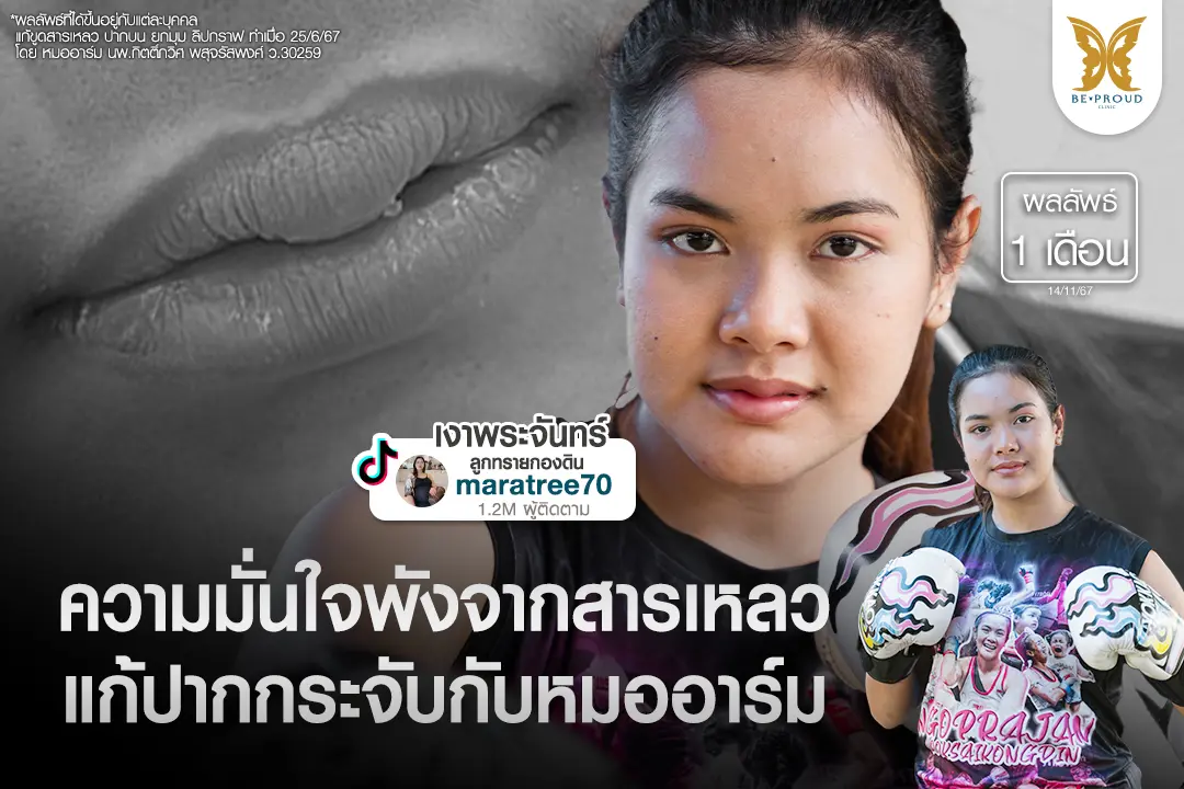 ภาพรีวิวคุณมาราตรี (เงาพระจันทร์) นักมวยหญิง แก้ปากกระจับขูดสารเหลวกับหมออาร์ม บีพราวด์คลินิกเปรียบเทียบผลลัพธ์หลังทำ 1 เดือน ทรงปากสวยธรรมชาติขึ้น