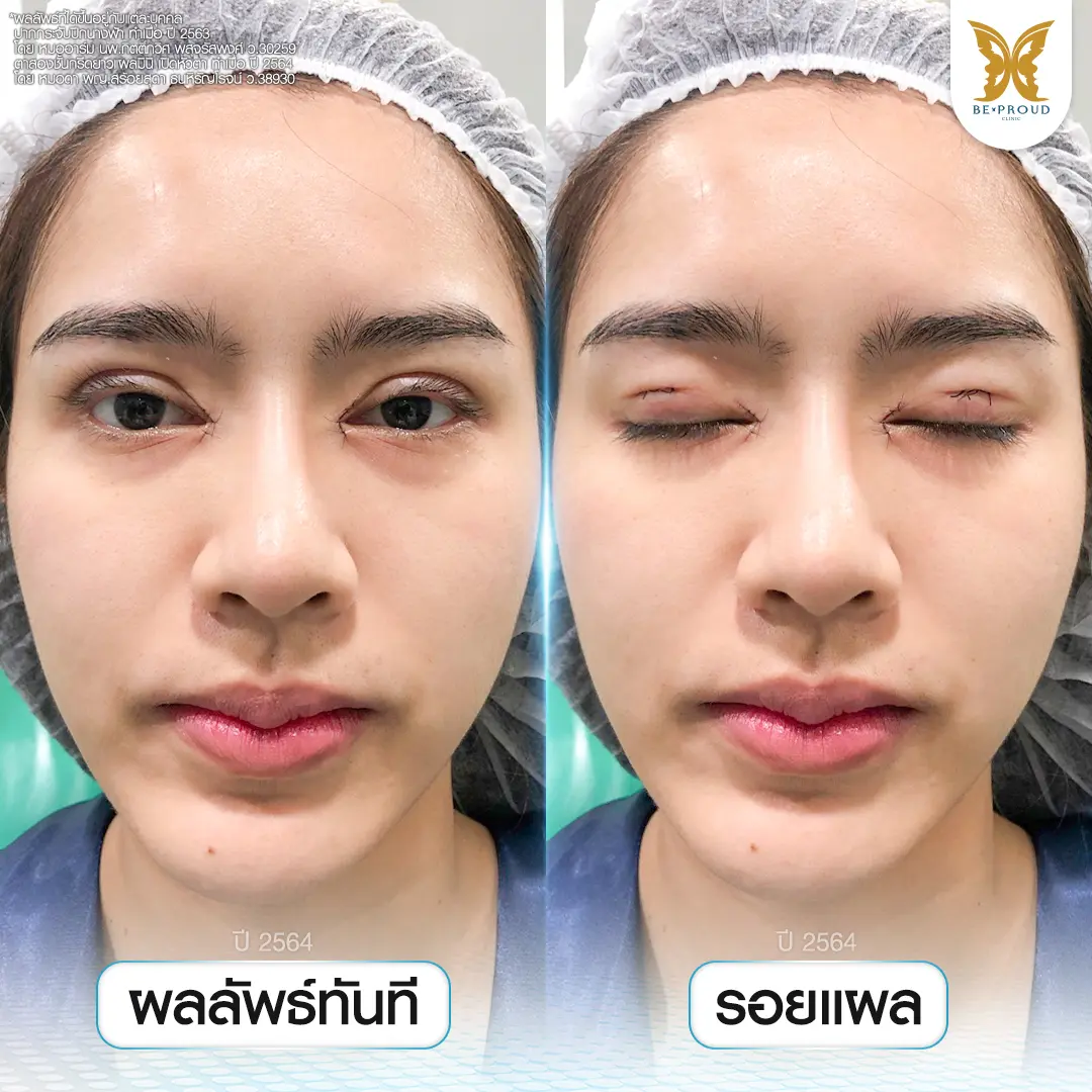 ภาพเปรียบเทียบผลลัพธ์ตาสองชั้นทันทีหลังทำและรอยแผลเย็บของคุณแอลตูน เทคนิคกรีดยาวแผลมินิและเปิดหัวตา โดยหมอดา บีพราวด์คลินิก ชั้นตาคมชัด แผลเนียนละเอียด
