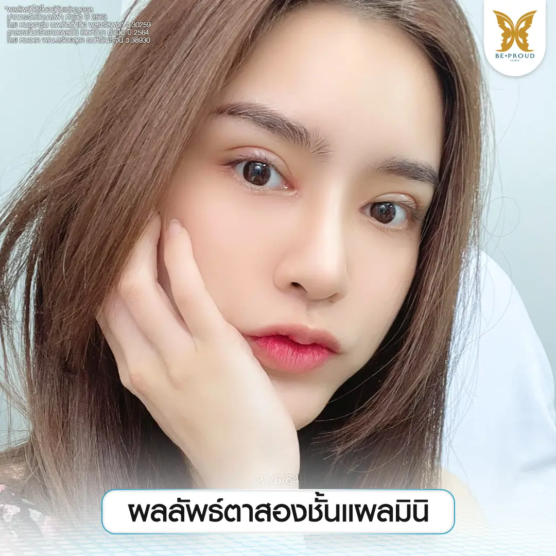 รีวิวผลลัพธ์ตาสองชั้นแผลมินิ คุณแอลตูน หลังทำกับหมอดา บีพราวด์คลินิก ได้ชั้นตาคมชัด ดวงตากลมโต สวยหวานละมุนเป็นธรรมชาติ