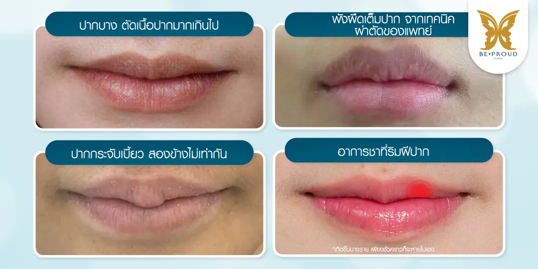 4 ผลเสียจากการทำปากกระจับที่ไม่ได้มาตรฐาน ได้แก่ ปากบางเกินไปตัดเนื้อออกเยอะ, เกิดพังผืดเป็นไตแข็ง, ปากเบี้ยวสองข้างไม่เท่ากัน, และอาการชาที่ริมฝีปาก ให้ความรู้โดย บีพราวด์คลินิก