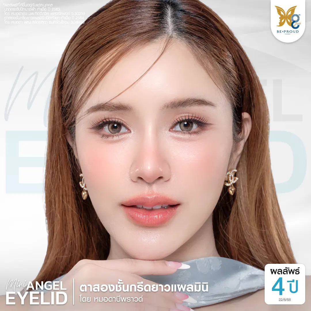 รีวิวผลลัพธ์ตาสองชั้นเทคนิค Mini Angel Eyelid ครบ 4 ปี โดยหมอดา บีพราวด์คลินิก ชั้นตาคมชัด แผลมินิ สวยหวานเป็นธรรมชาติ