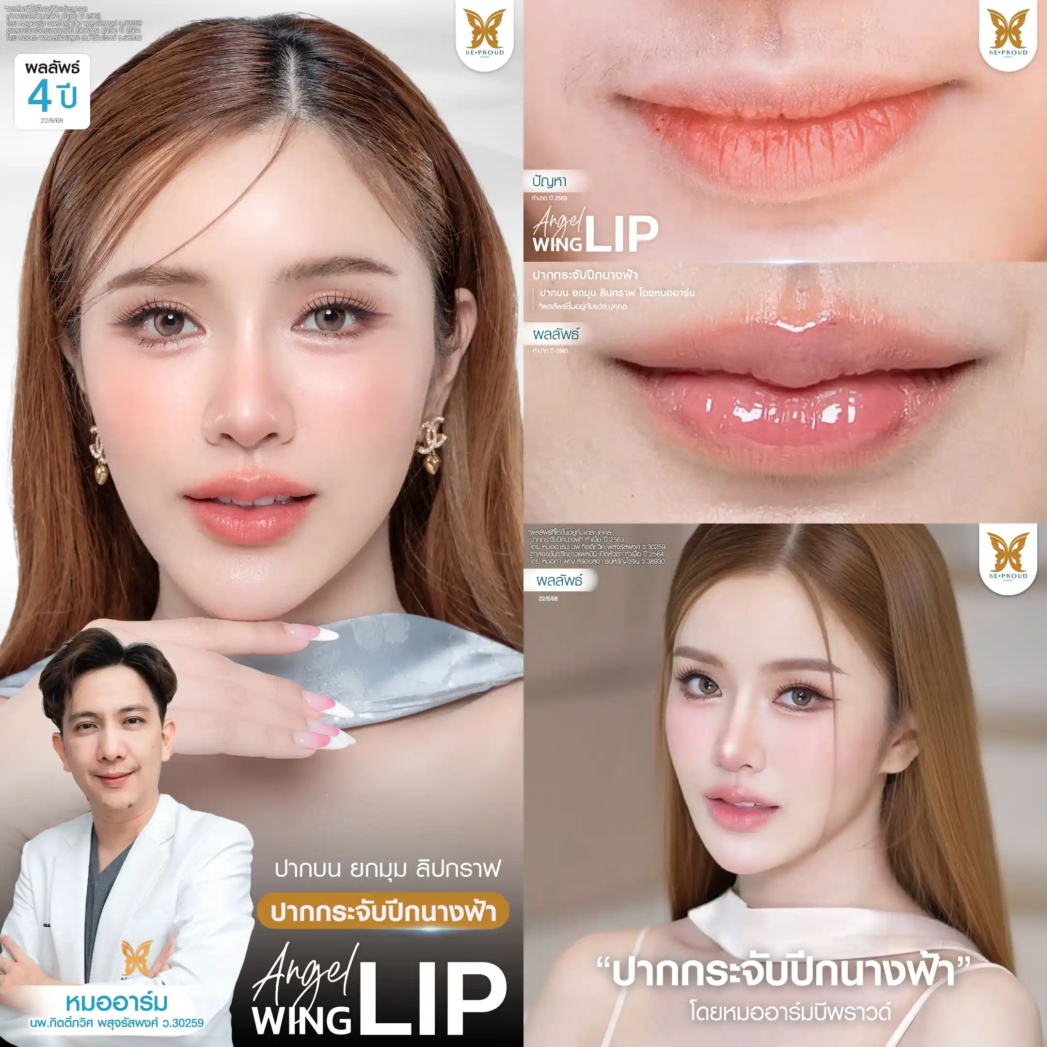 รีวิวผลลัพธ์ปากกระจับปีกนางฟ้าครบ 4 ปี ของคุณแอลตูน โดยหมออาร์ม บีพราวด์คลินิกเปรียบเทียบก่อนทำที่มีปัญหาปากหนาไม่เป็นทรง และหลังทำที่ได้ทรงปากกระจับสวยละมุนเป็นธรรมชาติ