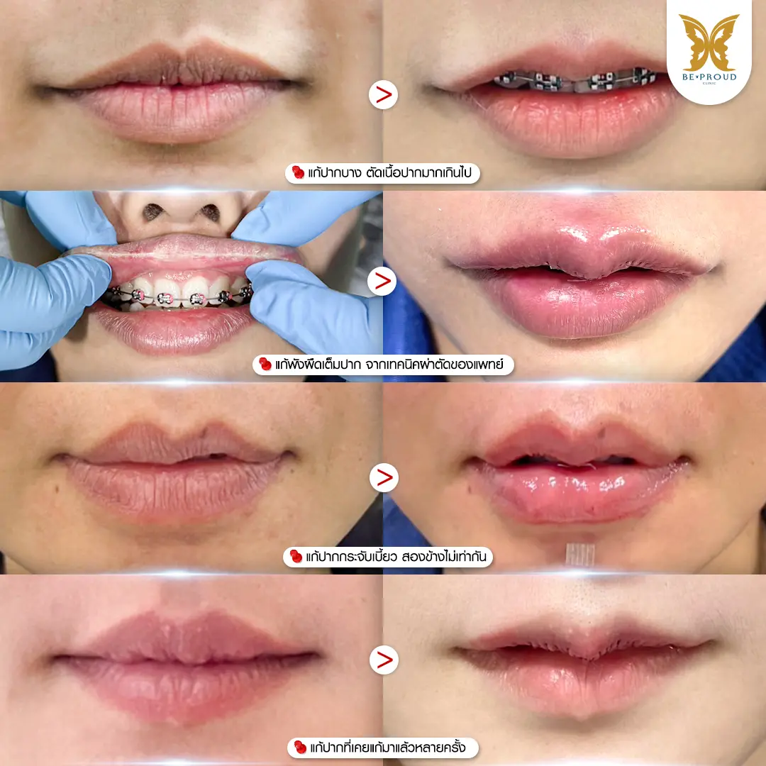 ภาพเปรียบเทียบก่อนและหลังศัลยกรรมแก้ปากกระจับ 4 เคส ได้แก่ แก้ปากบางเกินไปจากการตัดเนื้อมาก, เลาะพังผืดที่เป็นไตแข็ง, แก้ปากเบี้ยวสองข้างไม่เท่ากัน, และแก้เคสซ้ำซ้อน รักษาโดยบีพราวด์คลินิก