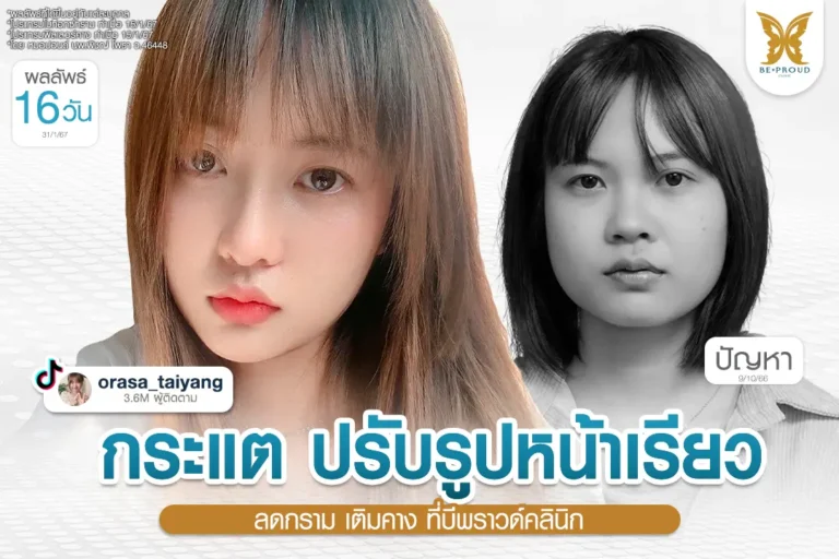 รีวิวปรับรูปหน้า คุณกระแต Orasa ลดกราม เติมคาง โปรแกรมโบท็อกซ์ ฟิลเลอร์คาง กับหมอปอนด์ บีพราวด์ คลินิก