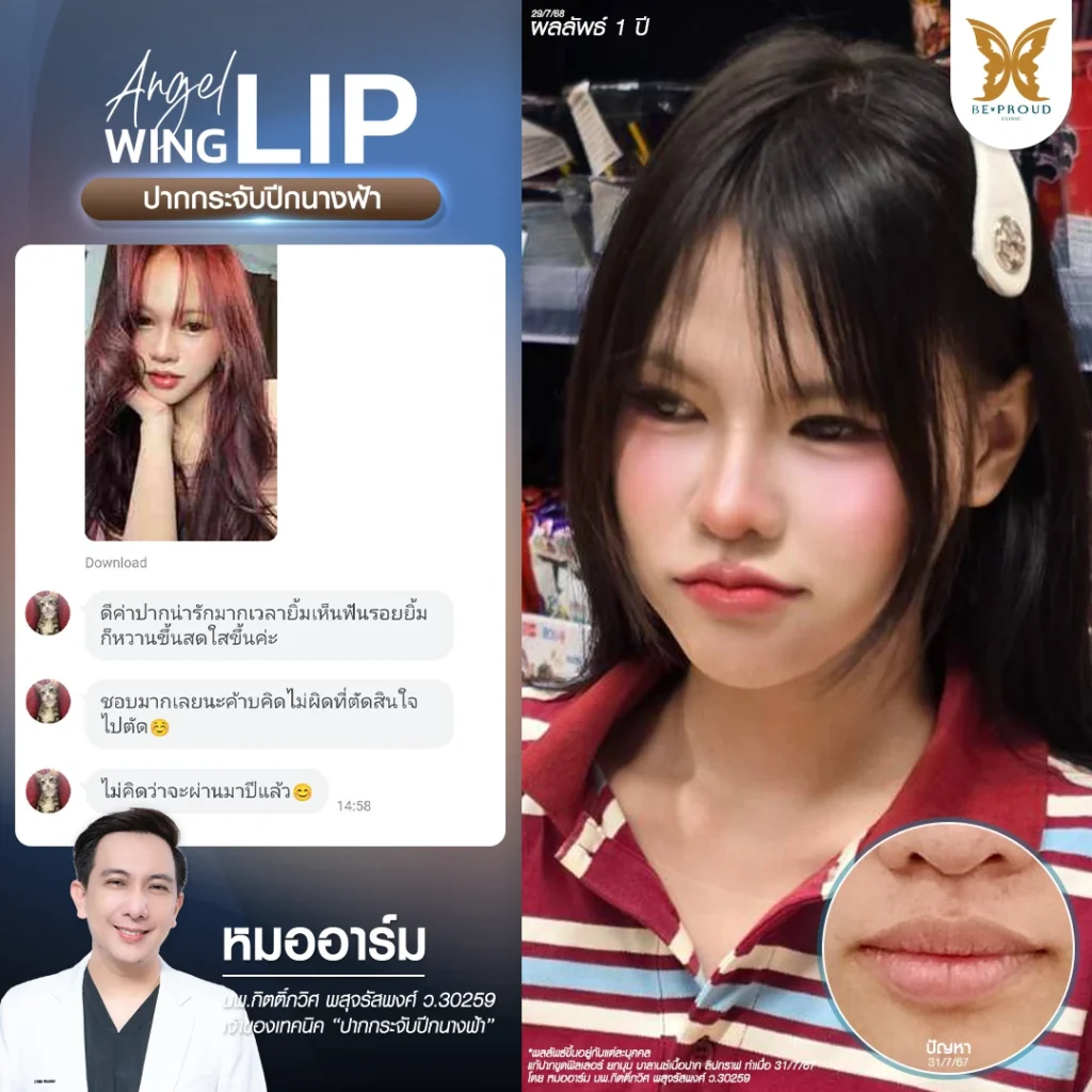 รีวิวปากกระจับปีกนางฟ้า ผลลัพธ์ระยะยาว 1 ปี ปากหวานละมุน โดยหมออาร์ม Beproud Clinic