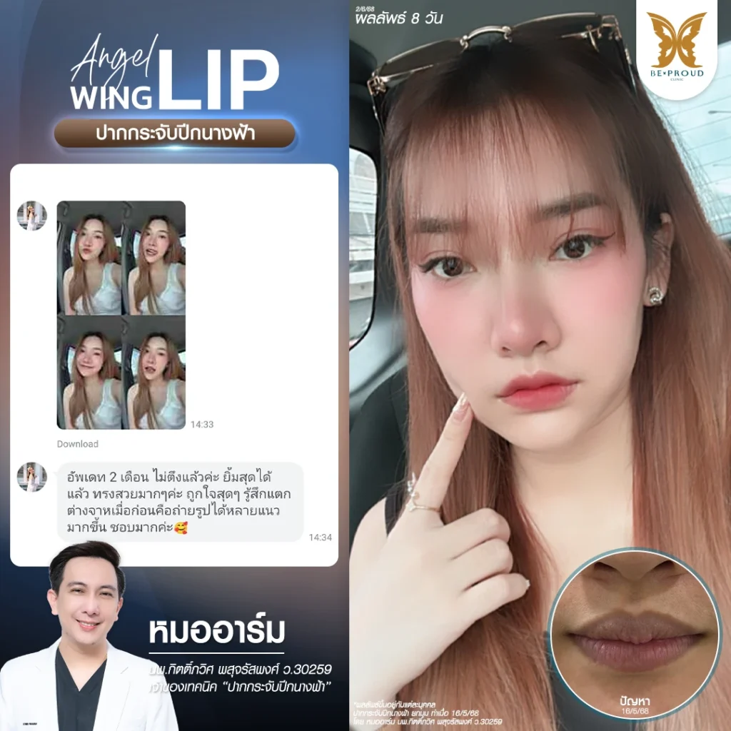 รีวิวปากกระจับ 8 วัน ทรงสวยหวานละมุน ยิ้มไม่ตึงรั้ง โดยหมออาร์ม Beproud Clinic