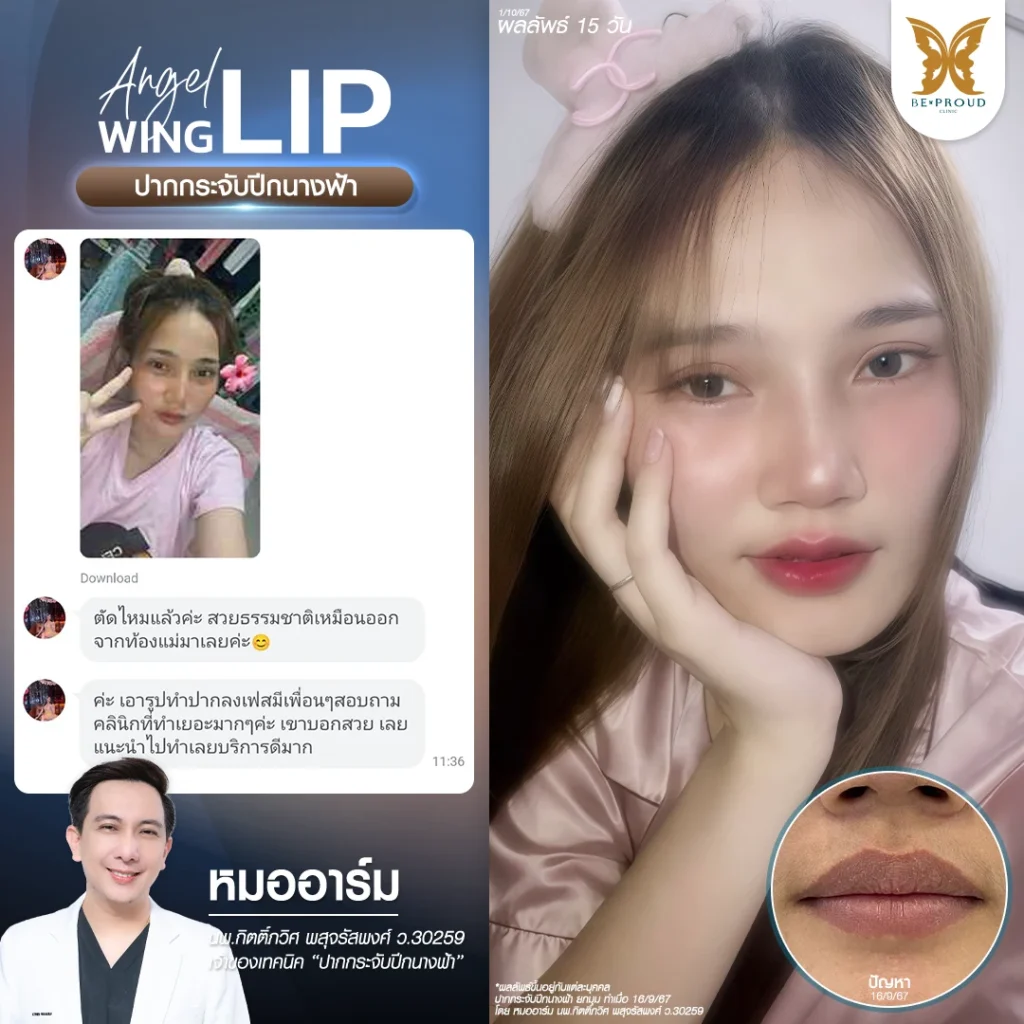 รีวิวปากกระจับ ทรงสวยธรรมชาติ เทคนิคปากกระจับปีกนางฟ้า โดยหมออาร์ม Beproud Clinic