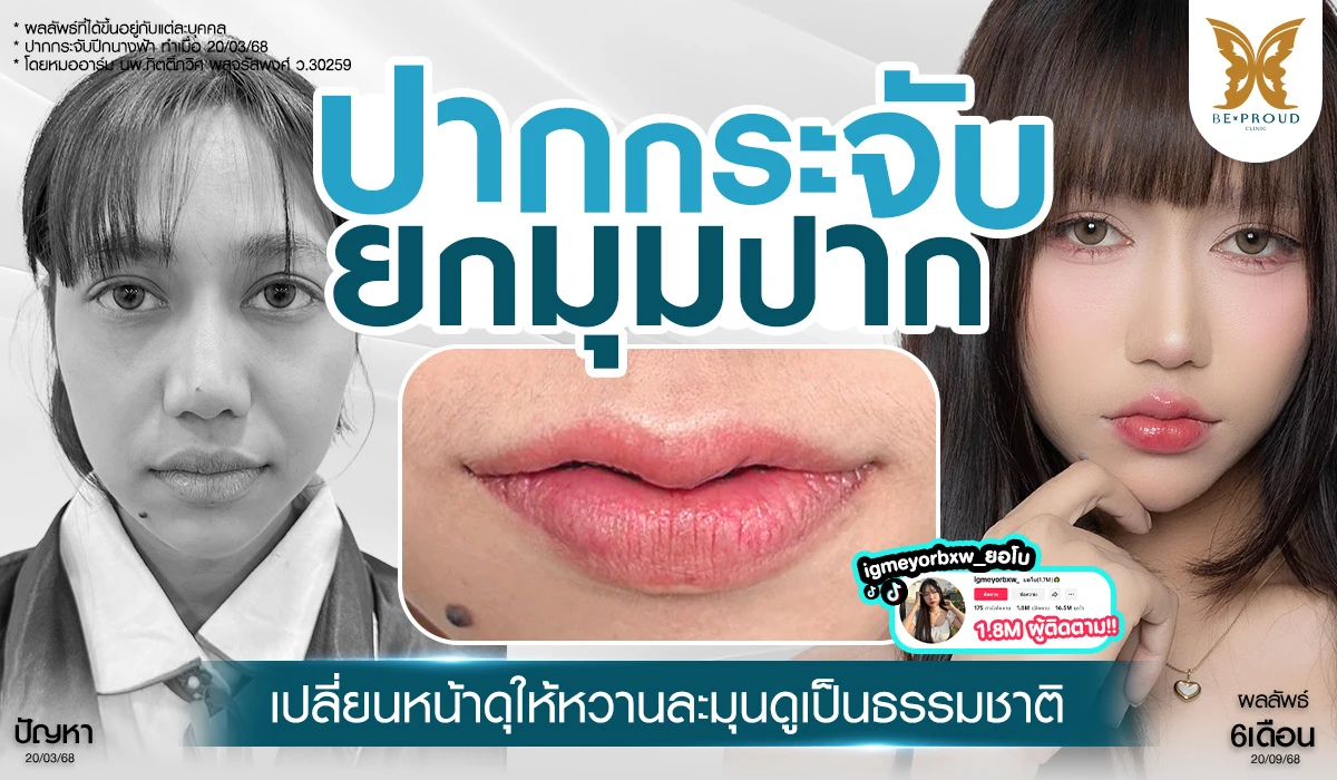 ปากกระจับ ยกมุมปาก เปลี่ยนหน้าดุให้หวานละมุนดูเป็นธรรมชาติ