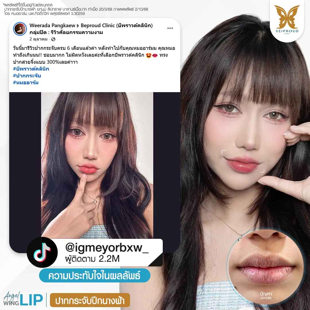 ปากกระจับ ยกมุมปาก เปลี่ยนหน้าดุให้หวานละมุนดูเป็นธรรมชาติ