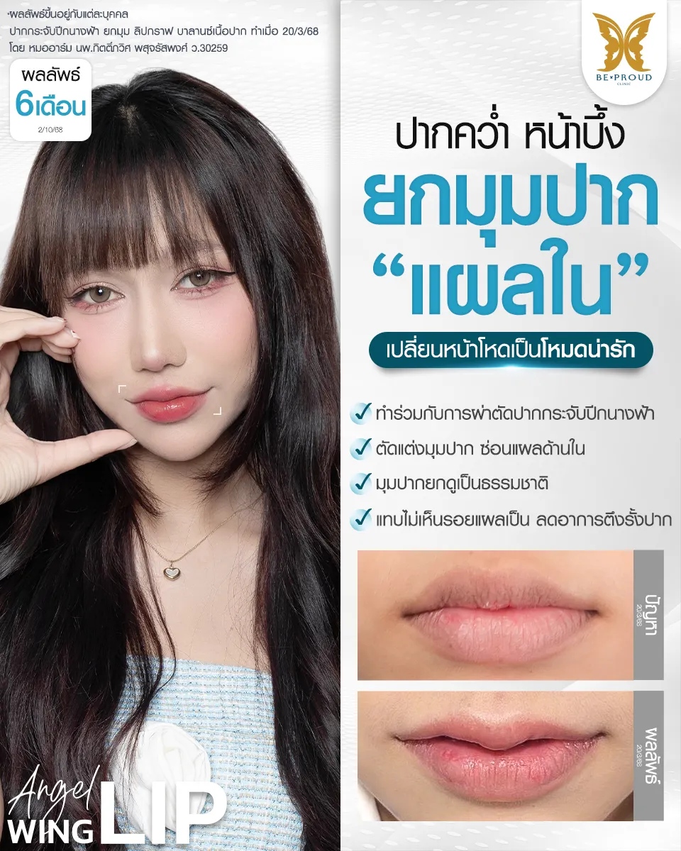 ปากกระจับ ยกมุมปาก เปลี่ยนหน้าดุให้หวานละมุนดูเป็นธรรมชาติ