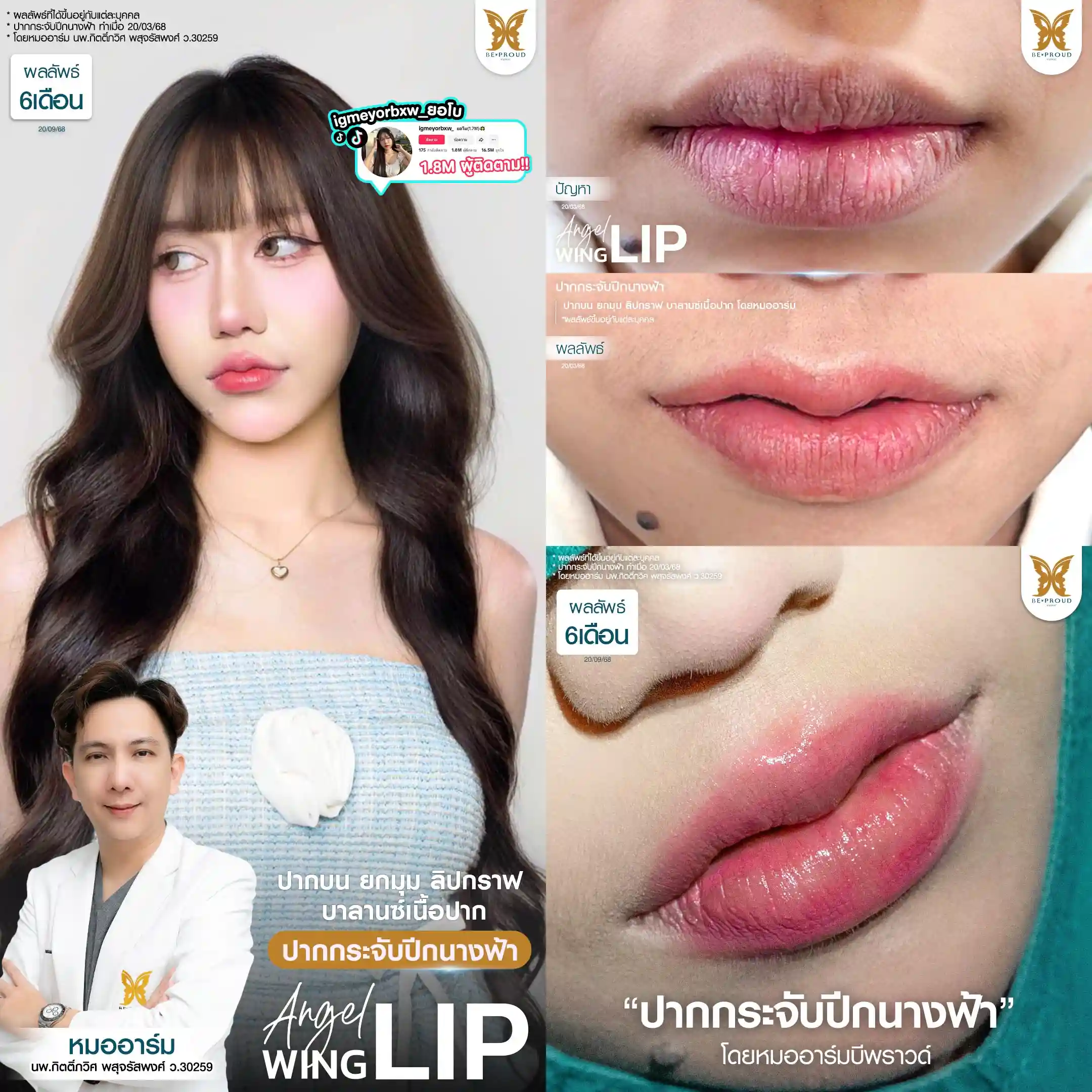 ปากกระจับ ยกมุมปาก เปลี่ยนหน้าดุให้หวานละมุนดูเป็นธรรมชาติ