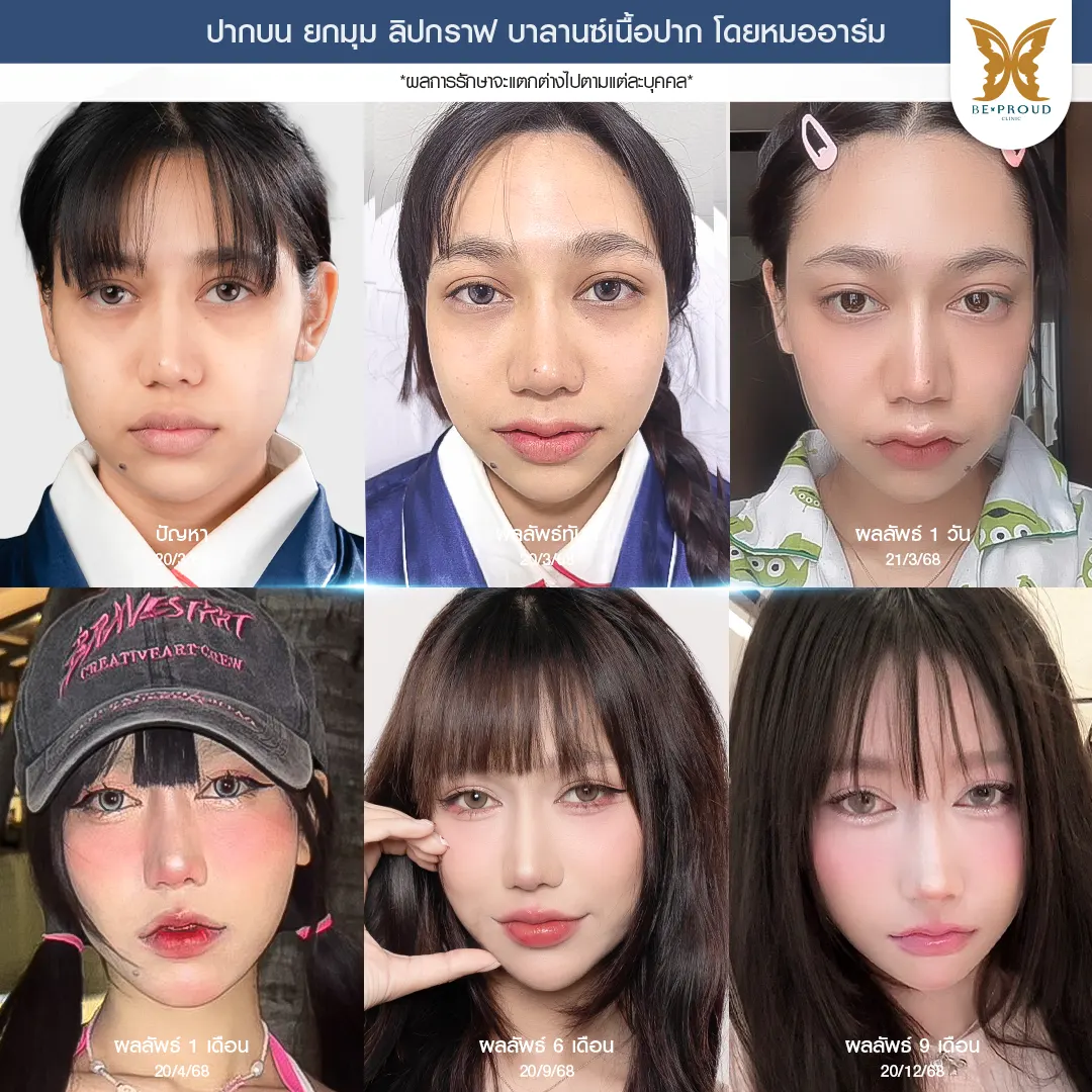 ปากกระจับ ยกมุมปาก เปลี่ยนหน้าดุให้หวานละมุนดูเป็นธรรมชาติ