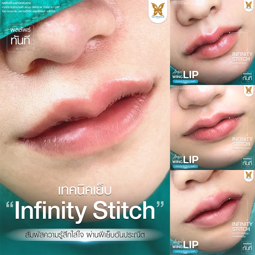 ปากกระจับ ยกมุมปาก เปลี่ยนหน้าดุให้หวานละมุนดูเป็นธรรมชาติ