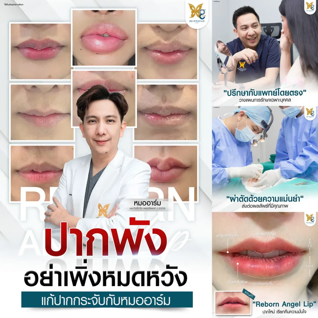 แก้ปากกระจับเทคนิค Reborn Angel Lip โดยหมออาร์ม บีพราวด์ คลินิก ปากพัง อย่าเพิ่งหมดหวัง รีวิวแก้ปากกระจับเคสยาก จากปากเป็นไต สู่ปากสวยปีกนางฟ้า