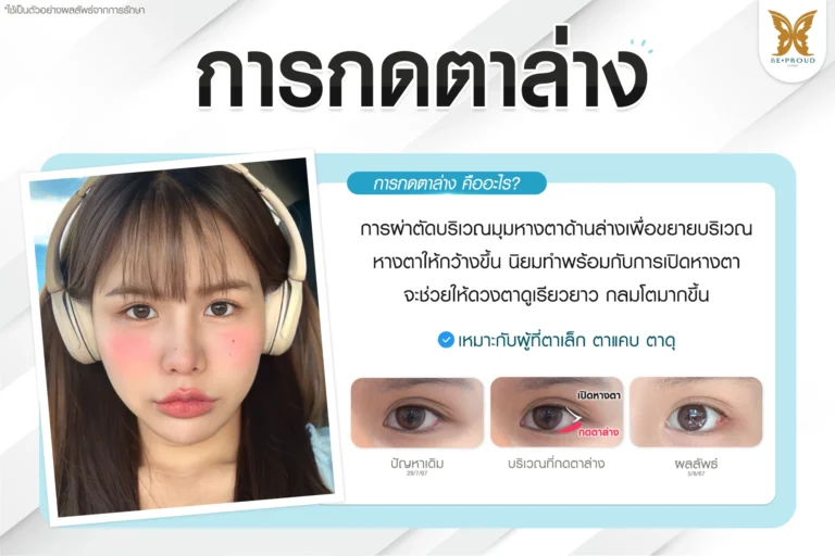 เทคนิคกดตาล่าง ปรับรูปตาให้กลมโตดูแบ๊วหวานละมุนสไตล์เกาหลี Beproud Clinic