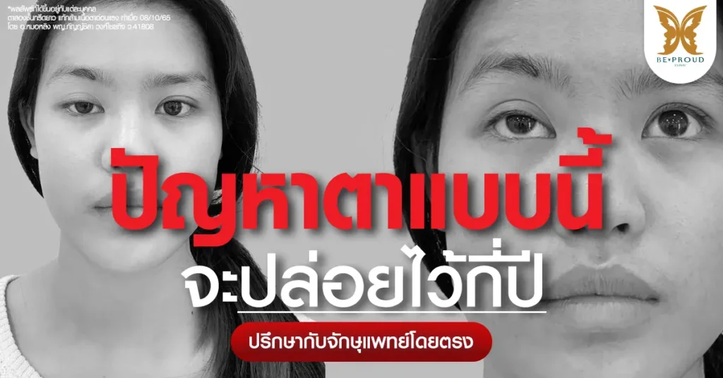 ภาพเคสตัวอย่างผู้ที่มีภาวะกล้ามเนื้อตาอ่อนแรง (Ptosis) ตาปรือ ตาตก ลืมตาไม่ขึ้น ก่อนรับการรักษาแก้กล้ามเนื้อตาอ่อนแรงโดยจักษุแพทย์ อ.หมอหลิง หมอต้น ที่บีพราวด์ คลินิก