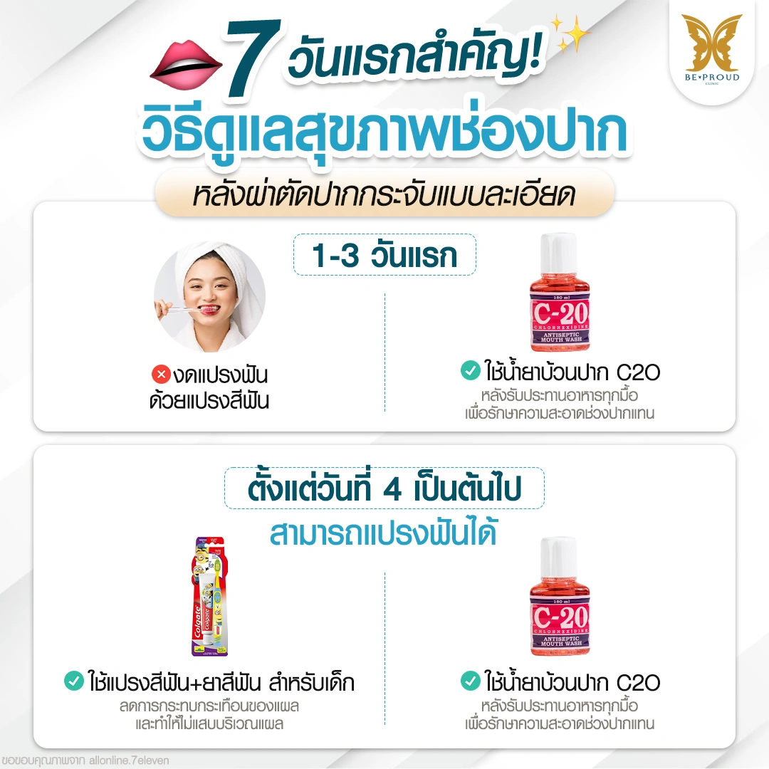 คู่มือ 7 วันแรก วิธีดูแลช่องปากหลังทำปากกระจับแบบละเอียด หลังทำปากกระจับต้องทำความสะอาดฟันยังไง? ทำตามนี้แผลไม่ติดเชื้อ