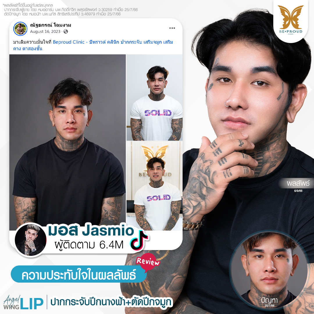 เปลี่ยนหน้าดุให้ดูซอฟต์สำเร็จ! การันตีความปัง เสียงยืนยันความประทับใจหลังศัลยกรรมปากกระจับเทคนิคปีกนางฟ้าและตัดปีกจมูก จากคุณมอส Jasmio อัปเดตลุคใหม่