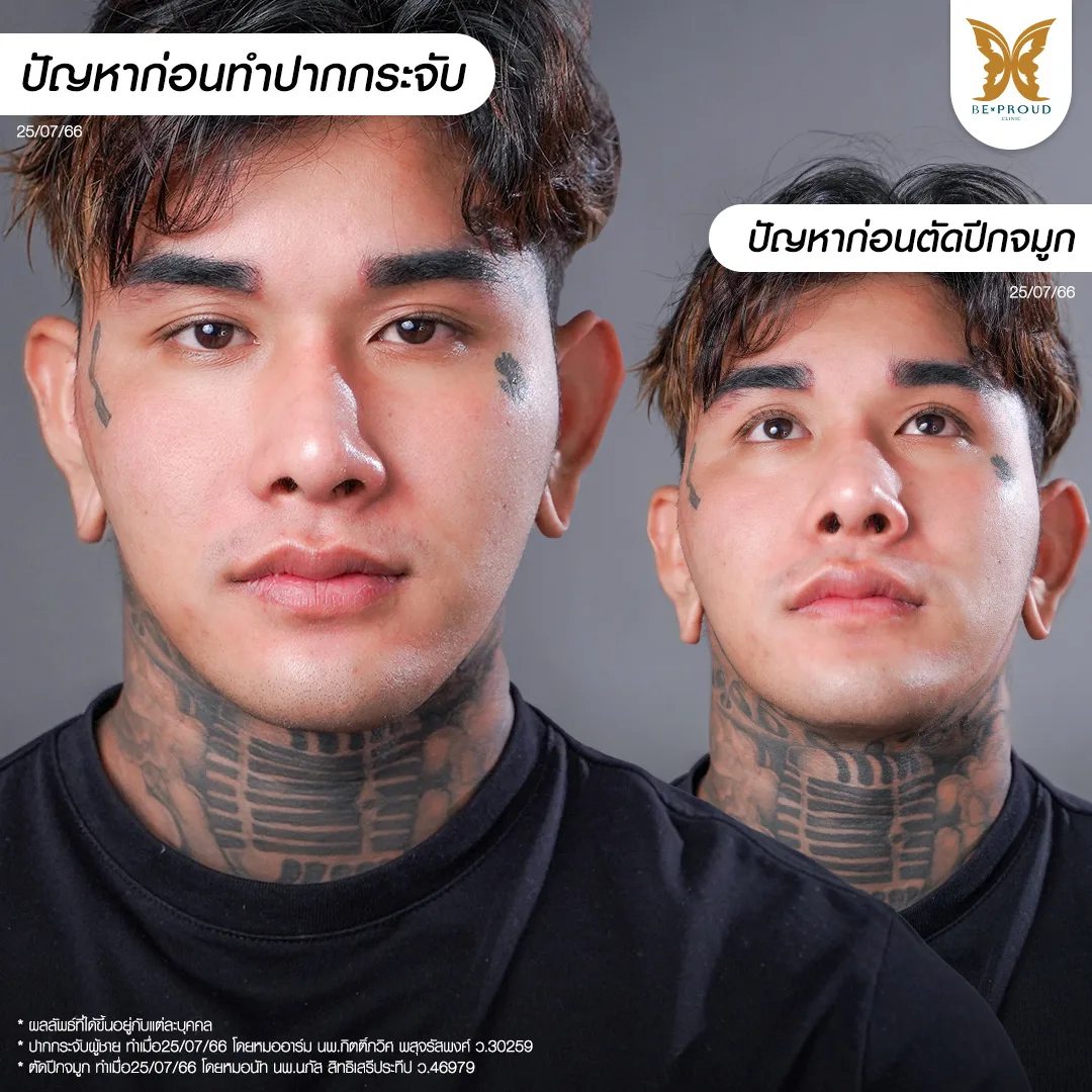วิเคราะห์โครงหน้าผู้ชาย คุณมอส Jasmio ก่อนทำศัลยกรรมแก้ไขที่ บีพราวด์ คลินิก ( Beproud Clinic ) ส่องปัญหาปากและจมูก ที่ทำให้หน้าดูแข็งและดุเกินไป