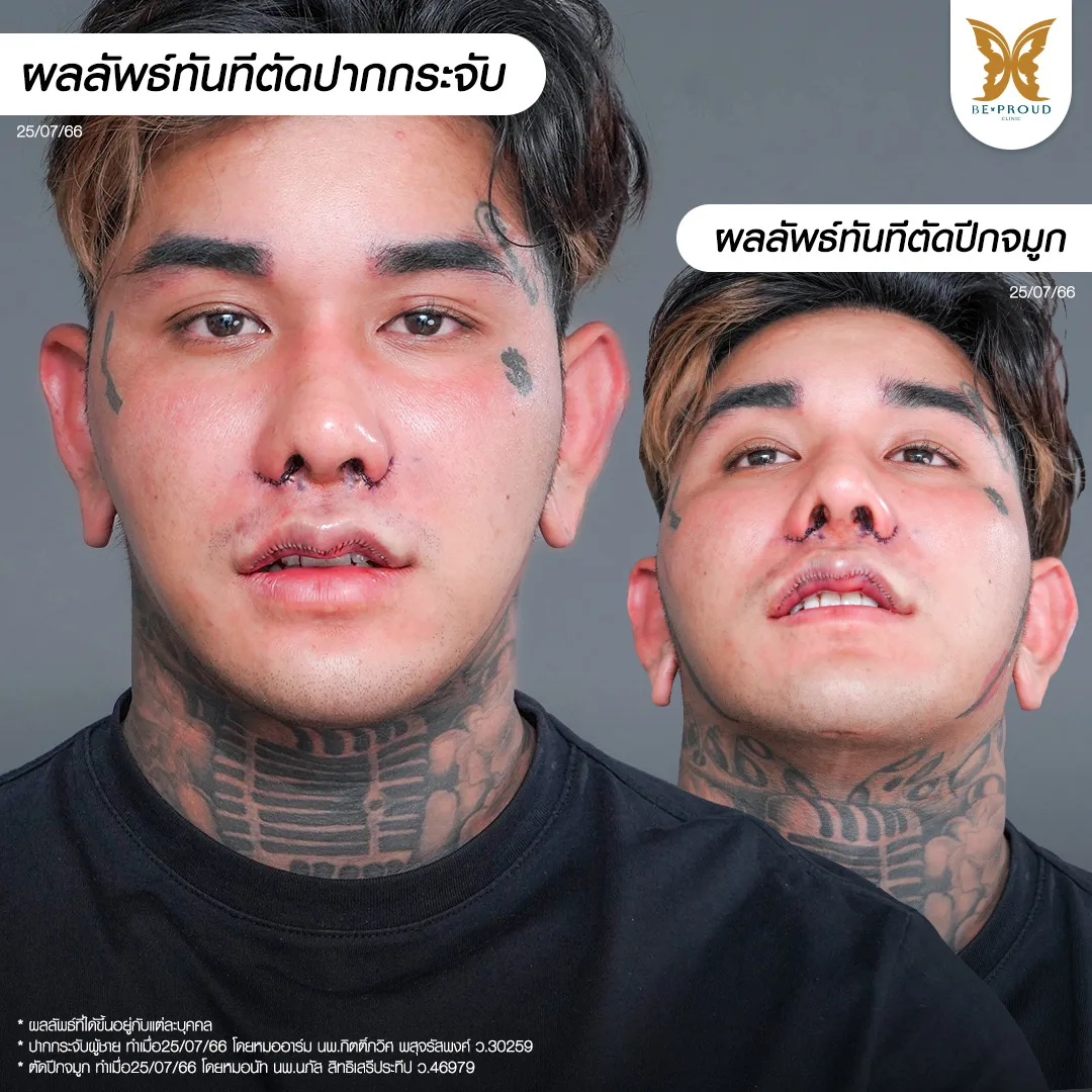 รีวิวแผลหลังทำศัลยกรรมทันที ผลลัพธ์รอยเย็บหลังศัลยกรรม แก้ปากกระจับ และ ตัดปีกจมูก คุณมอส Jasmio
