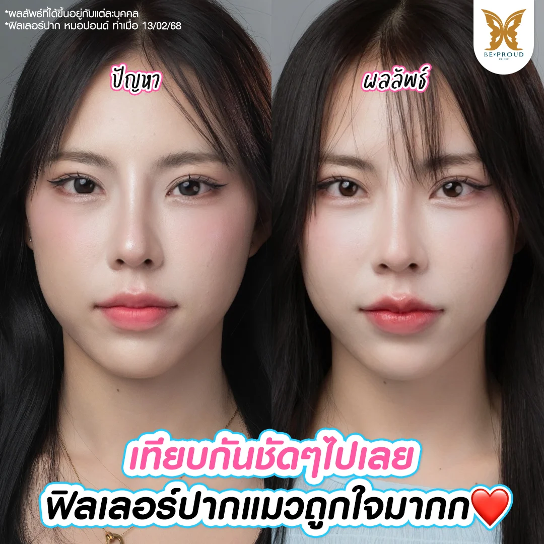 อัปเดตอาการหลังฉีดฟิลเลอร์ปากครบ 1 วัน ของน้องมีมี่ ที่ บีพราวด์ คลินิก ใบหน้าสดใสไร้รอยช้ำ ใช้ชีวิตได้ชิลล์ๆ จากฝีมือหมอปอนด์