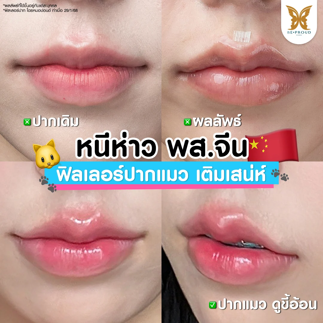 ภาพเปรียบเทียบก่อนและหลังฉีดฟิลเลอร์ปากทรงแมวของน้องมีมี่ ที่ บีพราวด์ คลินิก ผลลัพธ์ปากทรงกระจับ ยกมุมปากดูขี้อ้อนสไตล์พส.จีน เติมเสน่ห์