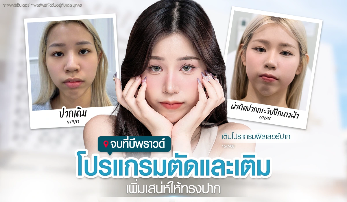 รีวิวโปรแกรมตัดและเติมริมฝีปากที่ Beproud Clinic คุณนิว @wichanew หลังผ่าตัดปากกระจับปีกนางฟ้า ผลลัพธ์หลังเติมโปรแกรมฟิลเลอร์ปากดูอวบอิ่มและละมุนขึ้น เพิ่มเสน่ห์ให้ทรงปาก