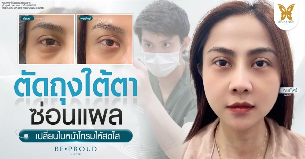 รีวิวเปรียบเทียบก่อนและหลังตัดถุงใต้ตาซ่อนแผล โดยหมอต้น Beproud Clinic เปลี่ยนหน้าโทรมให้สดใส ไร้รอยแผลเป็น
