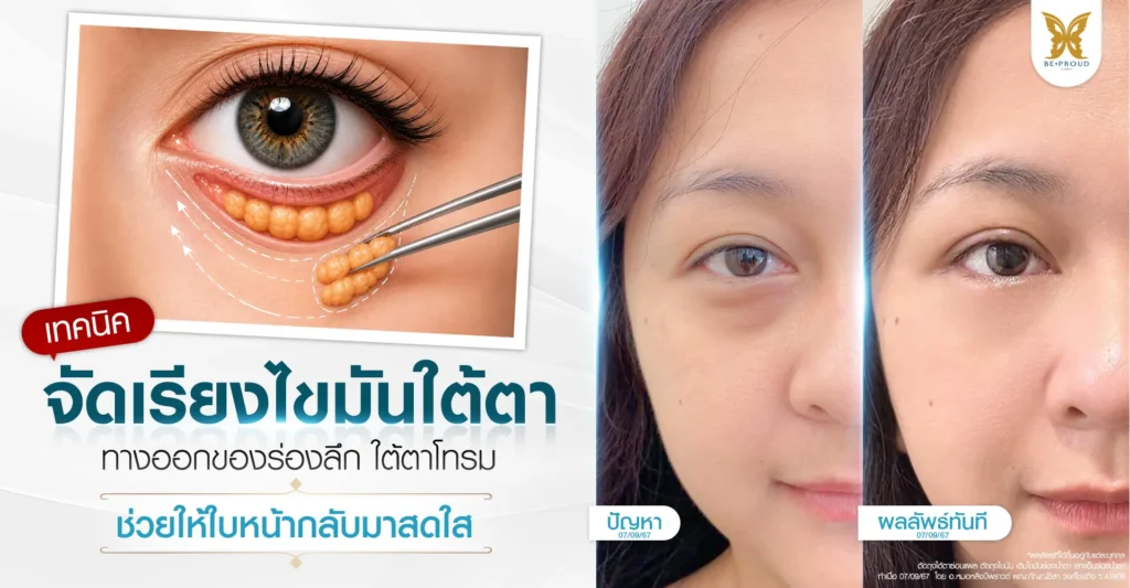 เทคนิคจัดเรียงไขมันใต้ตา เปรียบเทียบก่อนและหลังทำทันที แก้ปัญหาถุงใต้ตาและร่องลึก โดย อ.หมอหลิง Beproud Clinic