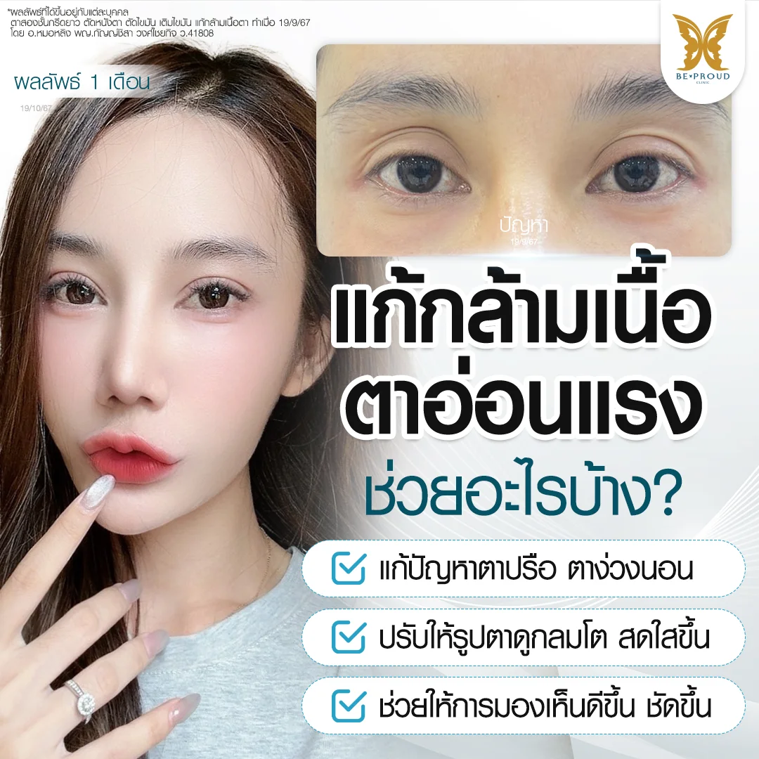 แก้กล้ามเนื้อตาอ่อนแรง ช่วยอะไรบ้าง? 3 ข้อดีของการแก้กล้ามเนื้อตาอ่อนแรง จบปัญหาตาปรือ คืนการมองเห็นที่ชัดเจน