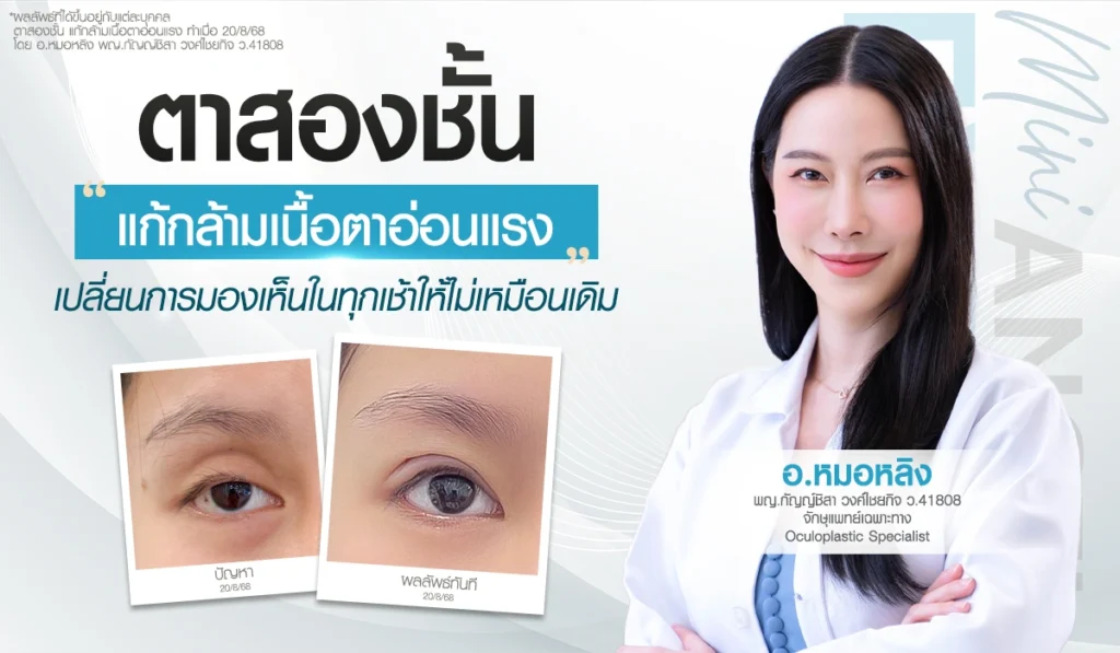 ตาสองชั้น แก้กล้ามเนื้อตาอ่อนแรง เปลี่ยนตาปรือเป็นตาสดใส โดย อ.หมอหลิง จักษุแพทย์เฉพาะทาง