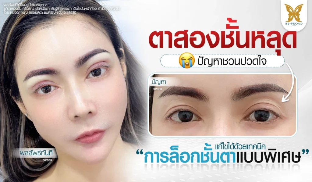 รีวิวแก้ตาสองชั้นหลุด เทคนิคล็อกชั้นตาแบบพิเศษ หมอดา อ.หมอหลิง Beproud Clinic