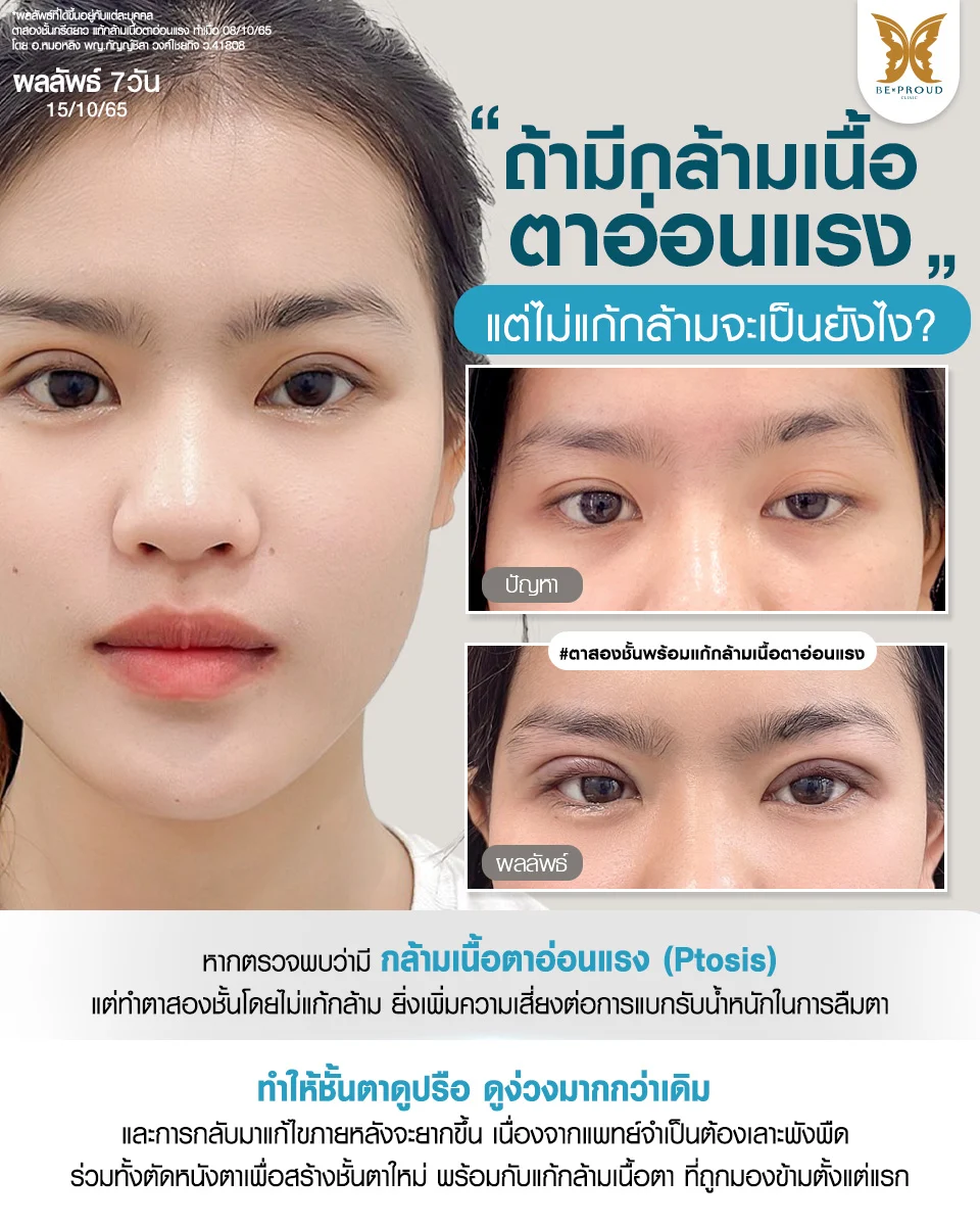 ผลเสียของการทำตาสองชั้นแต่ไม่แก้กล้ามเนื้อตาอ่อนแรง ไขข้อข้องใจโดยจักษุแพทย์