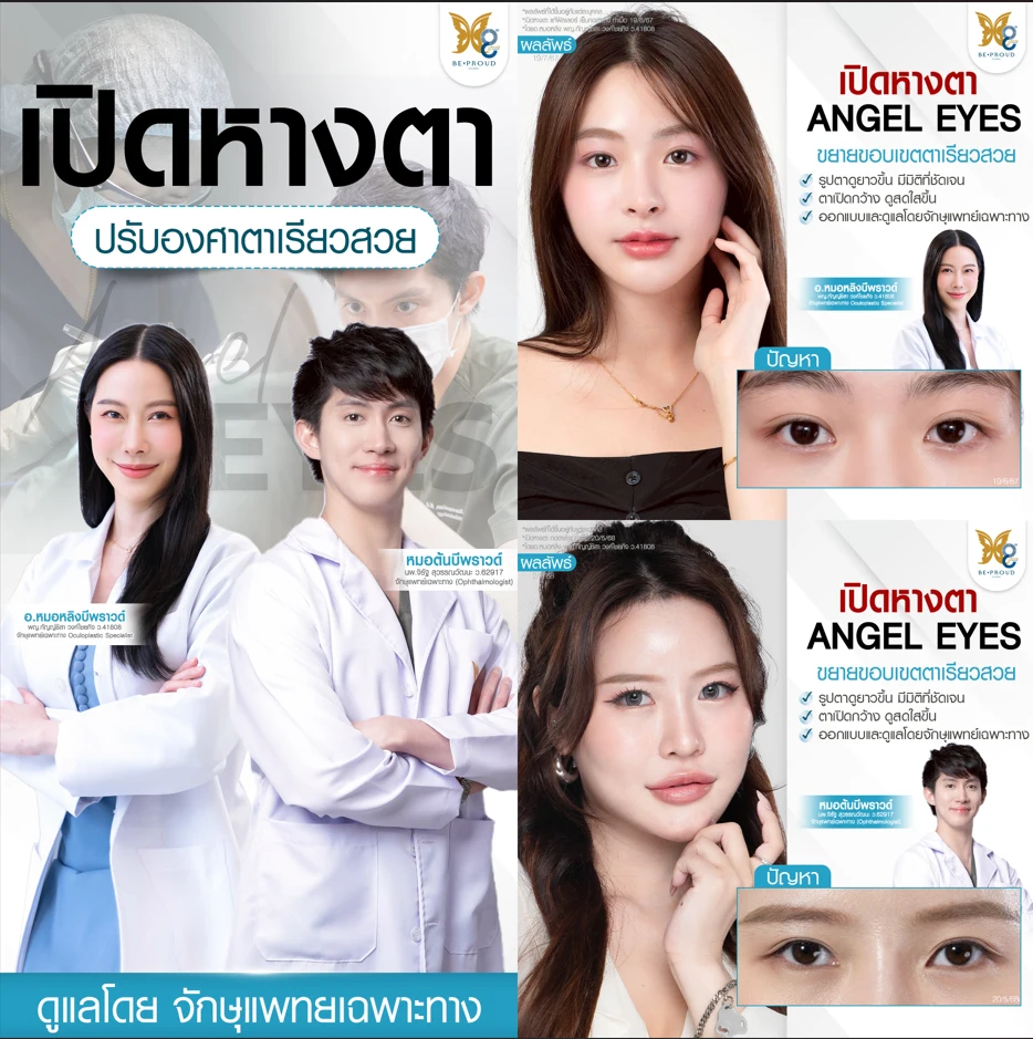 รีวิวเปิดหางตา ANGEL EYES ปรับองศาตาเรียวสวยสไตล์ พส.จีน โดยจักษุแพทย์เฉพาะทาง ที่ Beproud Clinic