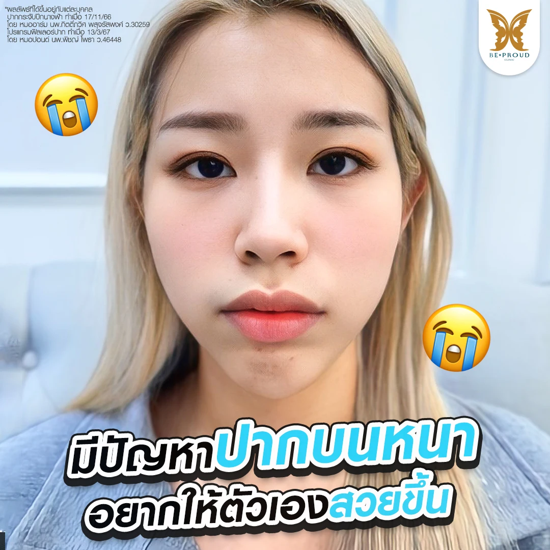 ขาดความมั่นใจเพราะ ปากหนา ทรงทื่อ ทำหน้าดุ ปัญหาก่อนทำศัลยกรรมปากกระจับของคุณนิว (@wichanew) ที่ Beproud Clinic