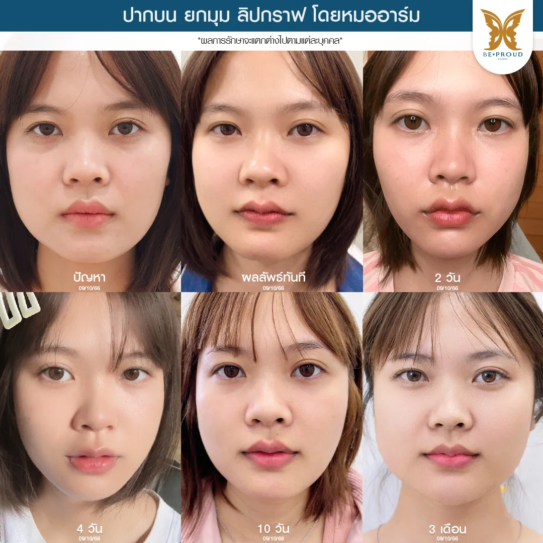 รีวิวไทม์ไลน์ศัลยกรรมปากกระจับของคุณกระแต Orasa โดยหมออาร์ม Beproud Clinic ด้วยเทคนิคตัดแต่งปากบน ยกมุมปาก และลิปกราฟ ผลลัพธ์เข้าที่ในระยะ 3 เดือน ทรงปากที่สวยละมุนขึ้นตามลำดับ