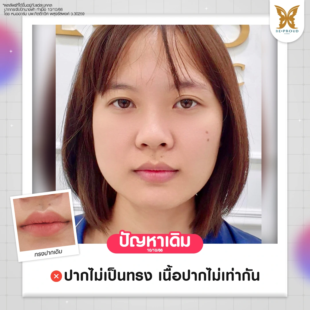 เปรียบเทียบปัญหาของคุณกระแต Orasa ก่อนทำศัลยกรรมที่ Beproud Clinic ริมฝีปากเดิม ปัญหาปากไม่เป็นทรง เนื้อปากไม่เท่ากัน