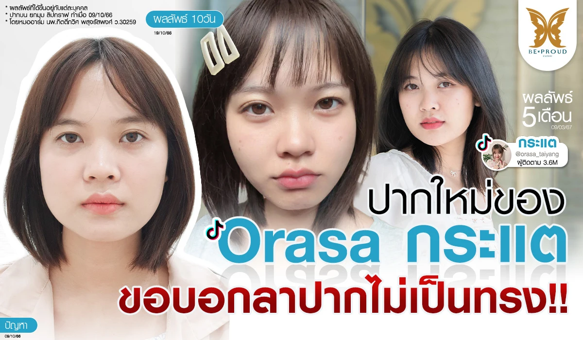 รีวิวศัลยกรรมปากกระจับของ คุณกระแต @orasa_taiyang เทคนิคตัดแต่งปากบน ยกมุมปาก และลิปกราฟ ดูแลโดยหมออาร์ม นพ.กิตติ์ภวิศ พสุจรัสพงศ์ Beproud Clinic