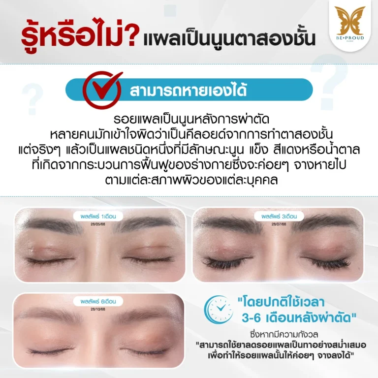 รู้หรือไม่? แผลเป็นนูนตาสองชั้น หายเองได้ ไม่ใช่คีลอยด์ Beproud Clinic