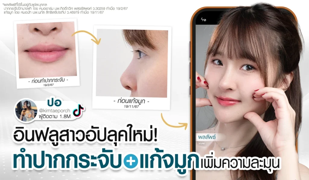 รีวิวศัลยกรรมปากกระจับและแก้จมูกของคุณปอ อินฟลูเอนเซอร์ ภาพเปรียบเทียบ Before-After หลังทำปากกระจับปีกนางฟ้าและจมูกทรง Slope Angel จาก Beproud Clinic