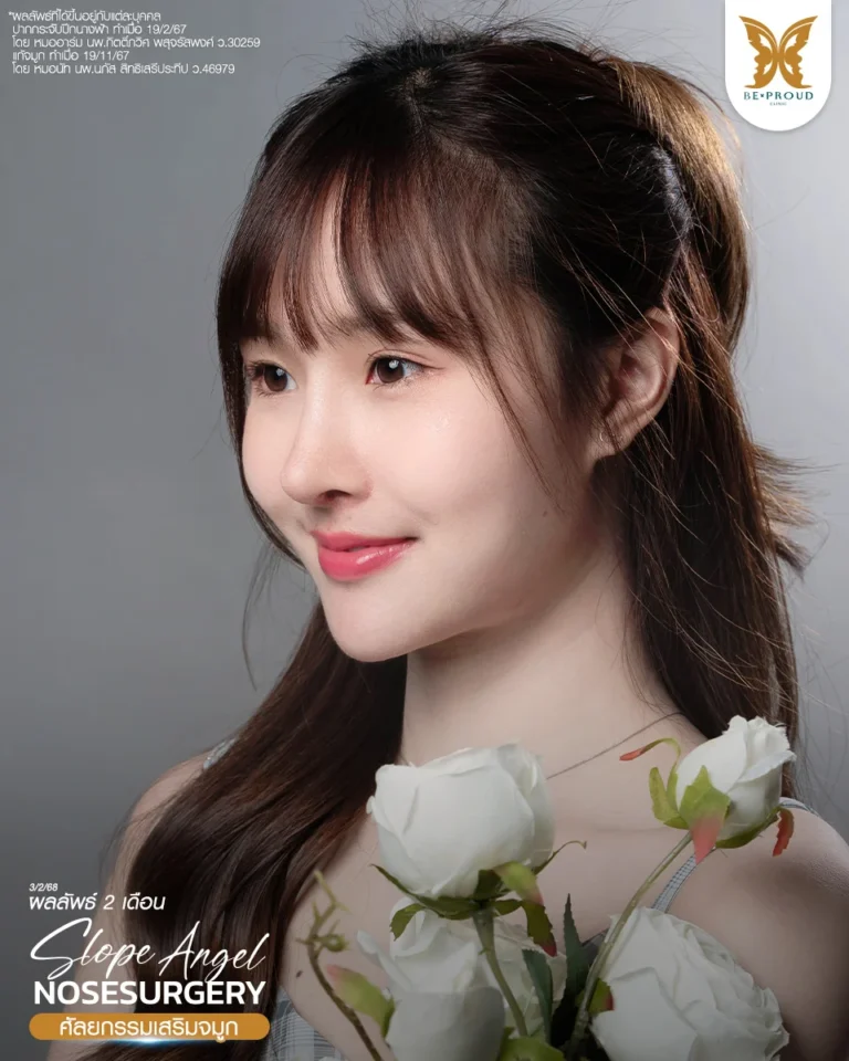 รีวิวคุณปอ อินฟลูเอนเซอร์ หลังแก้จมูกทรง Slope Angel ครบ 2 เดือน ผลลัพธ์จมูกสโลปสวยและปลายจมูกพุ่งละมุน ผลลัพธ์จากการใช้ซิลิโคนแมสทิสรองปลายกระดูกอ่อนหลังหู โดยหมอนัท Beproud Clinic