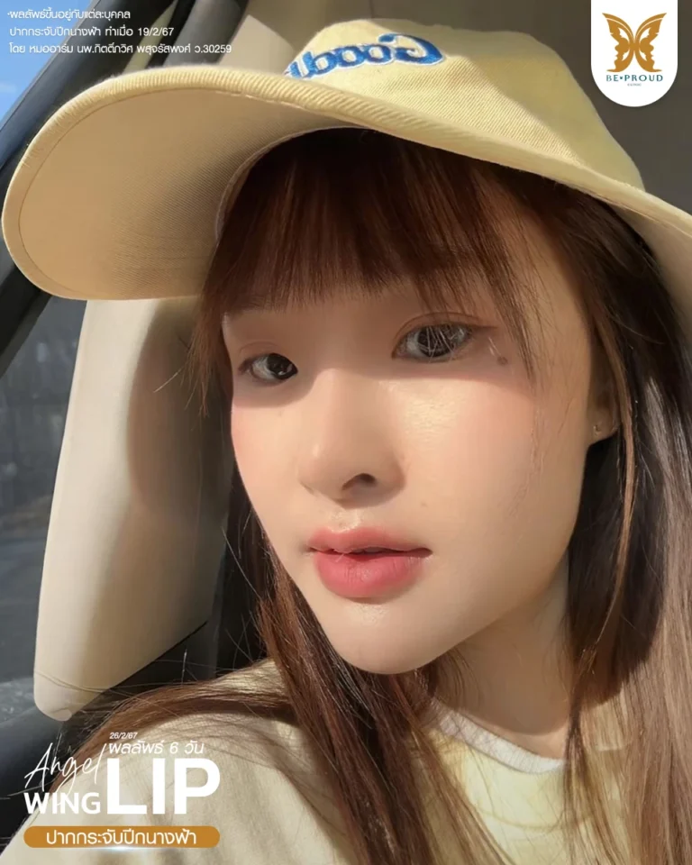 ภาพคุณปอ อินฟลูเอนเซอร์ อวดลุคสวยหลังทำปากกระจับปีกนางฟ้าครบ 6 วัน ทรงปากดูเป็นกระจับสวยงาม มุมปากยก ดูหวานละมุนรับกับใบหน้า โดยหมออาร์ม Beproud Clinic