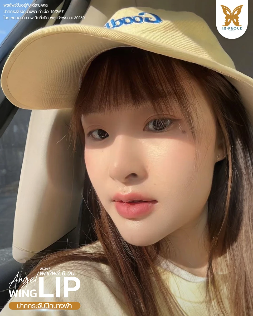 ศัลยกรรม ปากกระจับและแก้จมูก อินฟลูสาวอัปลุคใหม่! ทำศัลยกรรม ปากกระจับ+แก้จมูก เพิ่มความละมุน!!