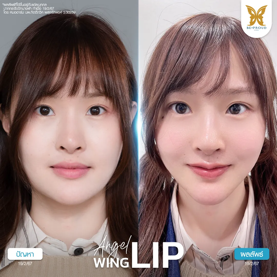 ศัลยกรรม ปากกระจับและแก้จมูก อินฟลูสาวอัปลุคใหม่! ทำศัลยกรรม ปากกระจับ+แก้จมูก เพิ่มความละมุน!!